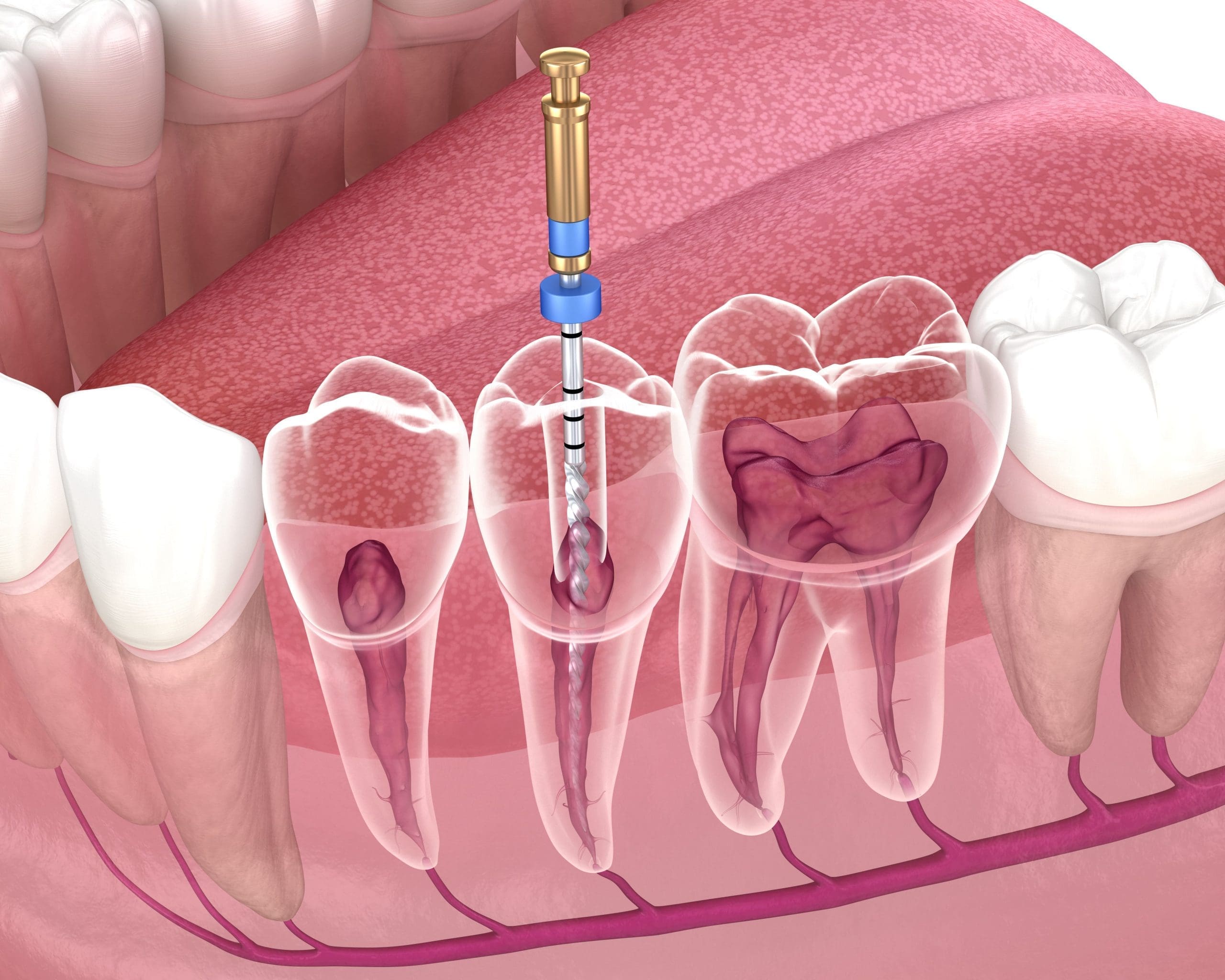 Arlington Heights Root Canal Therapy